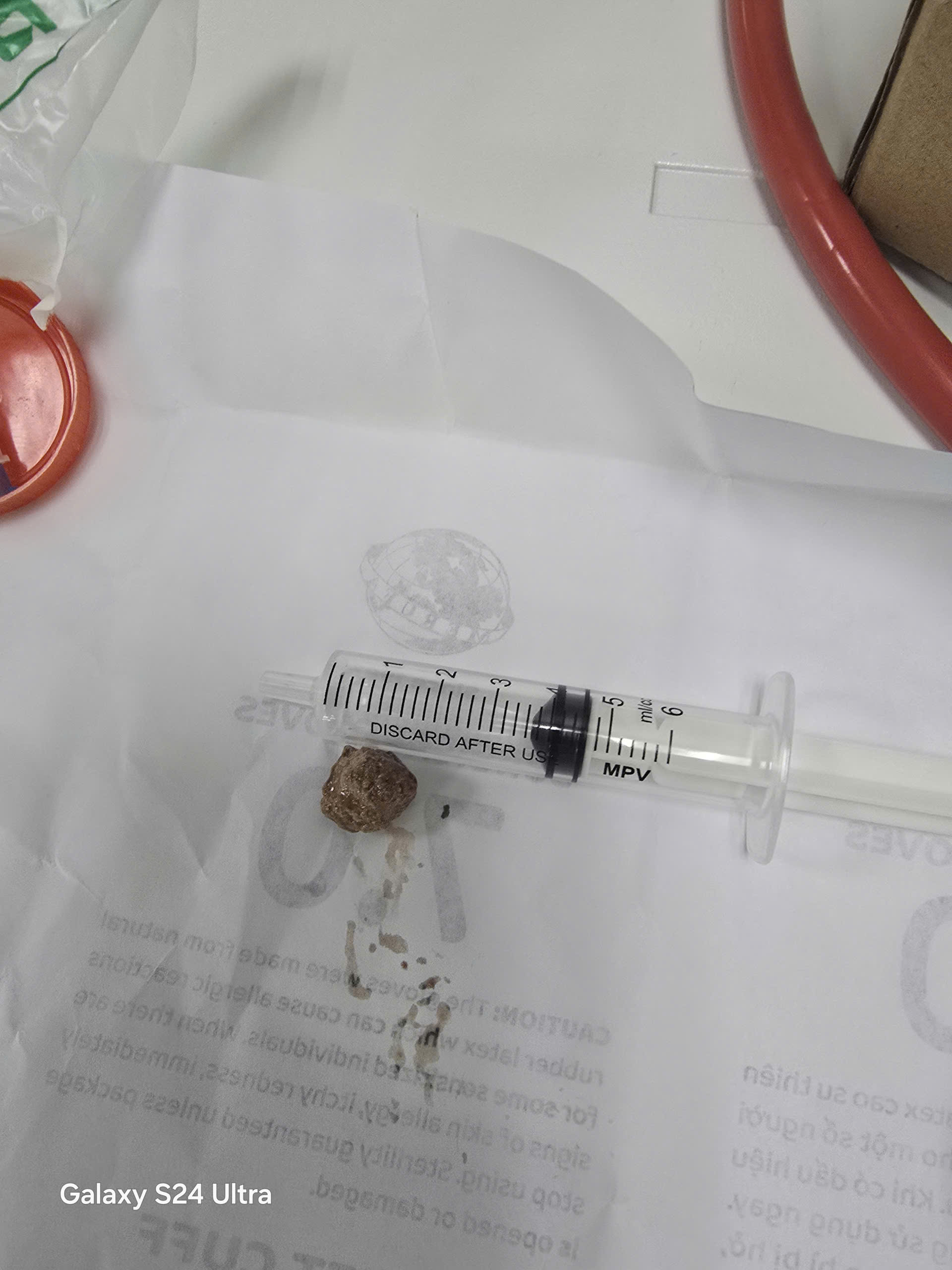 BỆNH VIỆN ĐA KHOA KHU VỰC CẨM PHẢ NỘI SOI LẤY SỎI NIỆU QUẢN KÍCH THƯỚC 2CM, NGĂN NGỪA BIẾN CHỨNG NGUY HIỂM