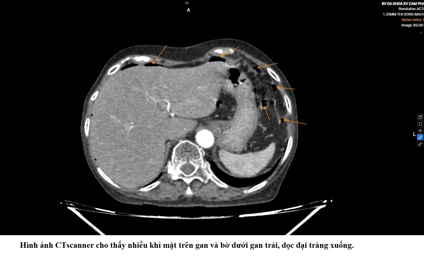 LIÊN TIẾP CA THỦNG TẠNG RỖNG  Ở NGƯỜI CAO TUỔI - CẢNH BÁO NGUY CƠ BỎ SÓT TRIỆU CHỨNG BAN ĐẦU