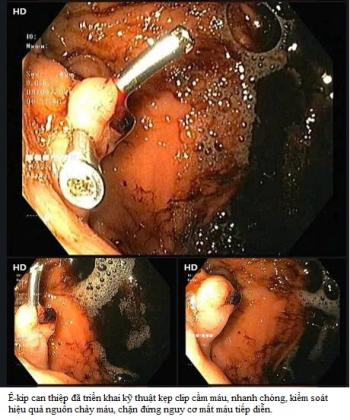 GIÀNH LẠI SỰ SỐNG TRONG “GIỜ VÀNG”: Dấu ấn từ một ca cấp cứu xuất huyết tiêu hóa nặng tại Bệnh viện ĐKKV Cẩm Phả.