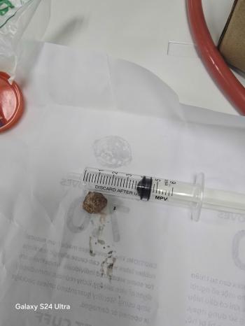 BỆNH VIỆN ĐA KHOA KHU VỰC CẨM PHẢ NỘI SOI LẤY SỎI NIỆU QUẢN KÍCH THƯỚC 2CM, NGĂN NGỪA BIẾN CHỨNG NGUY HIỂM