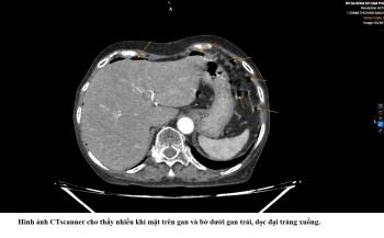 LIÊN TIẾP CA THỦNG TẠNG RỖNG  Ở NGƯỜI CAO TUỔI - CẢNH BÁO NGUY CƠ BỎ SÓT TRIỆU CHỨNG BAN ĐẦU