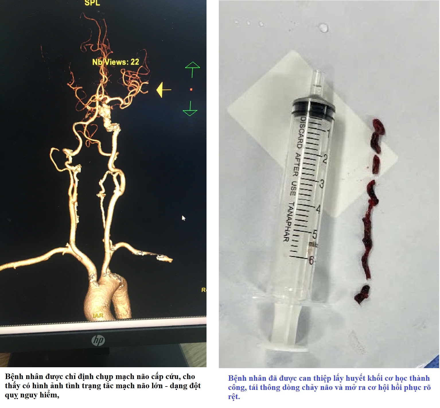 BỆNH VIỆN ĐA KHOA KHU VỰC CẨM PHẢ CẤP CỨU ĐỘT QUỴ KỊP THỜI - PHỐI HỢP LIÊN TUYẾN HIỆU QUẢ.
