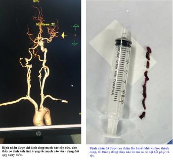 BỆNH VIỆN ĐA KHOA KHU VỰC CẨM PHẢ CẤP CỨU ĐỘT QUỴ KỊP THỜI - PHỐI HỢP LIÊN TUYẾN HIỆU QUẢ.