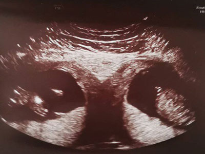 Hiếm gặp: sản phụ mang thai đôi ở hai tử cung khác nhau