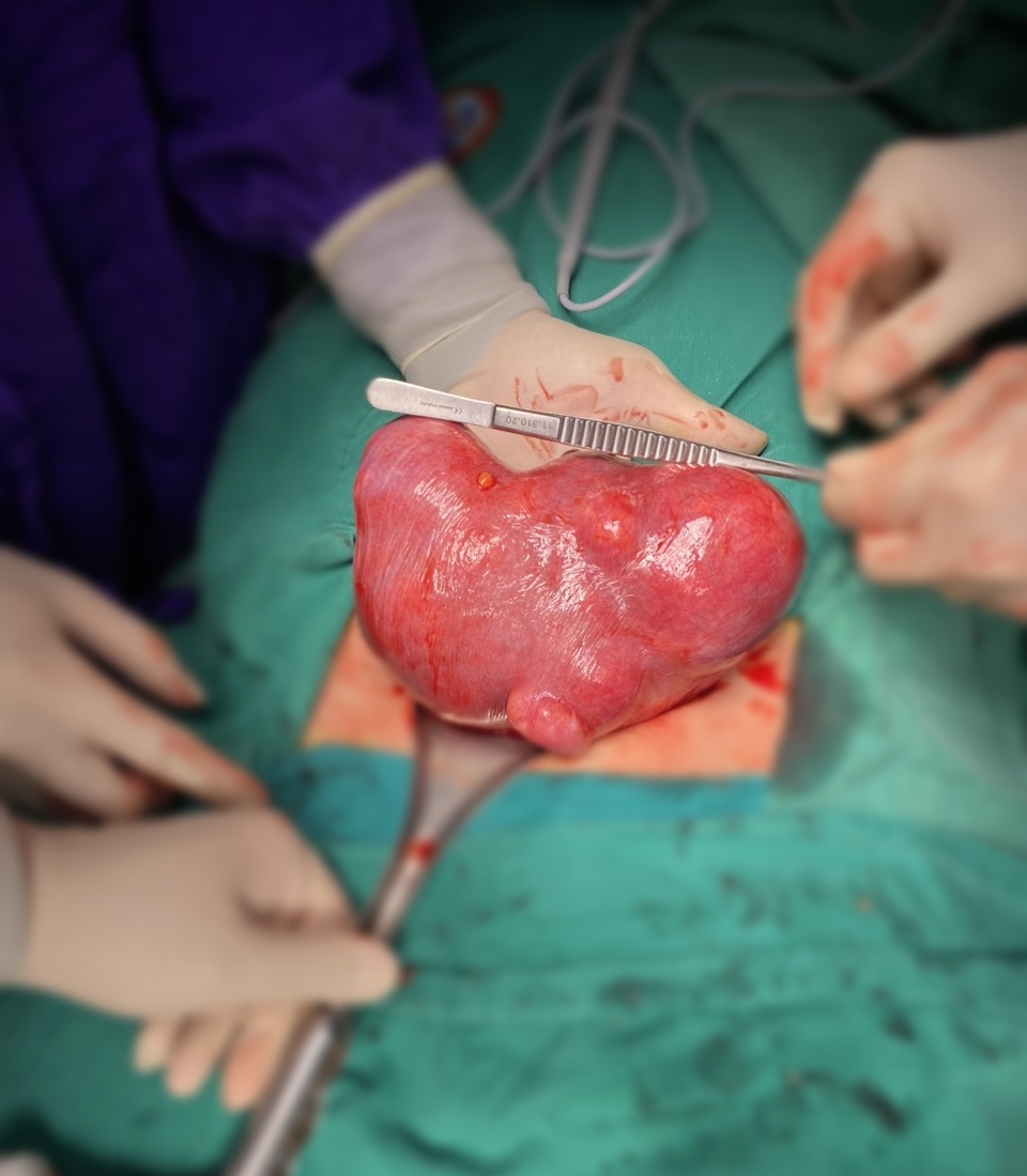 Phẫu thuật cắt bỏ u xơ tử cung nặng hơn 2 kg tại Bệnh viện Đa khoa khu vực Cẩm Phả