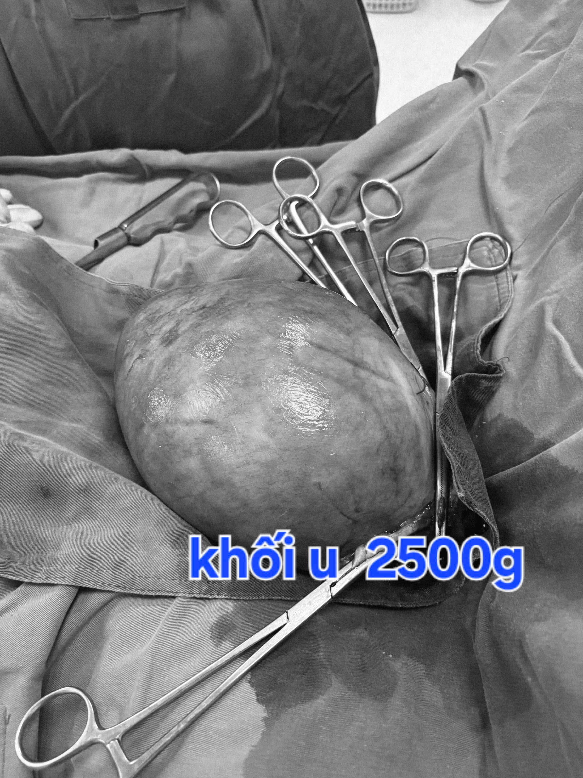 BỆNH VIỆN ĐA KHOA KHU VỰC CẨM PHẢ: CA PHẪU THUẬT “KÉP”, GIÚP NGƯỜI BỆNH THOÁT KHỎI HAI BỆNH LÝ LỚN CHỈ TRONG MỘT CA MỔ.
