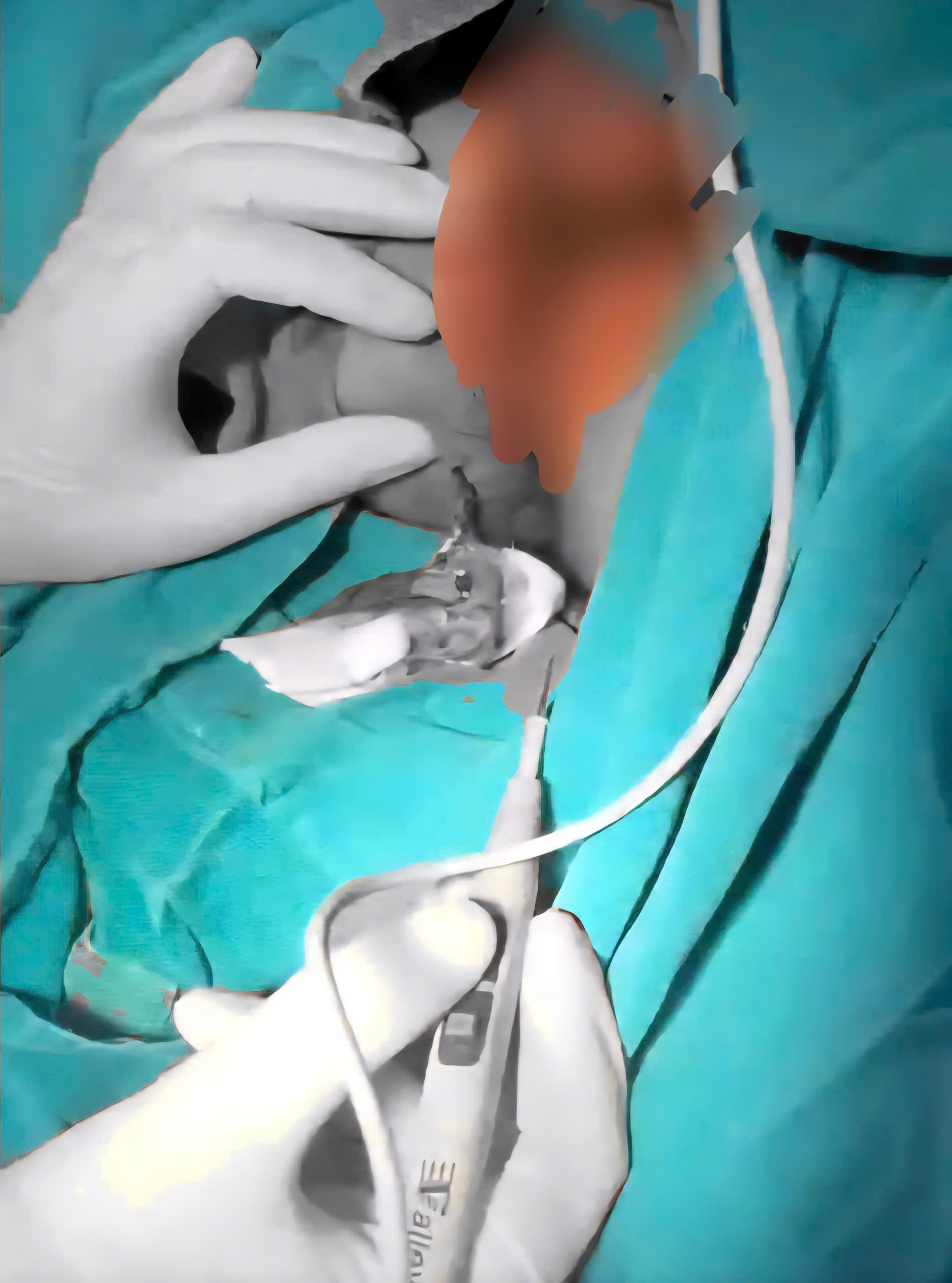 BỆNH VIỆN ĐKKV CẨM PHẢ: ĐỪNG COI NHẸ MỘT CƠN ĐAU - BÀI HỌC TỪ CA MỔ CẤP CỨU Ổ ÁP XE Ở CẠNH HẬU MÔN.