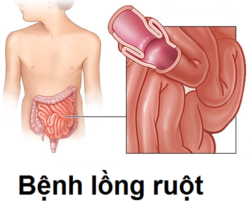 CẢNH BÁO: LỒNG RUỘT Ở TRẺ EM - PHÁT HIỆN SỚM, ĐIỀU TRỊ KỊP THỜI ĐỂ BẢO TOÀN TÍNH MẠNG.