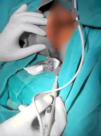 BỆNH VIỆN ĐKKV CẨM PHẢ: ĐỪNG COI NHẸ MỘT CƠN ĐAU - BÀI HỌC TỪ CA MỔ CẤP CỨU Ổ ÁP XE Ở CẠNH HẬU MÔN.